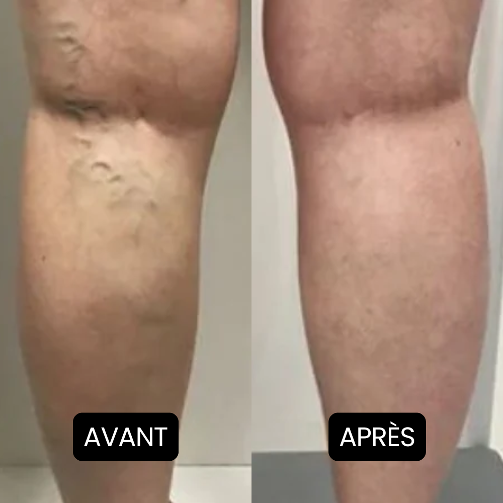 Nervalis – Crème Apaisante Pour Jambes Gonflées ( Lot de 80 )